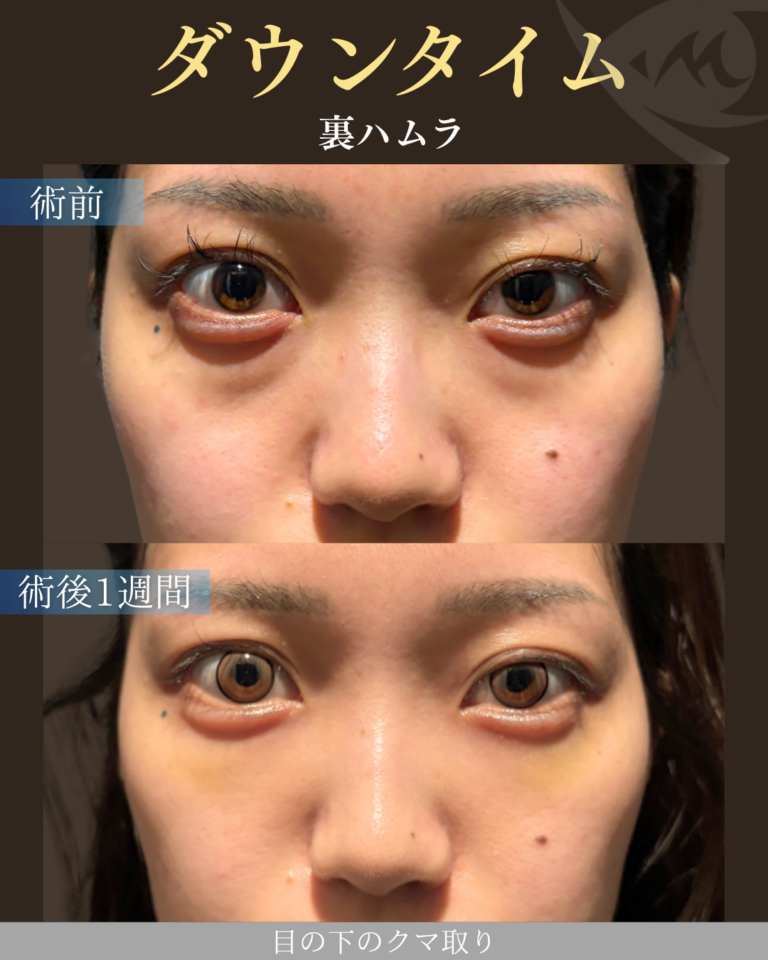 20代女性 裏ハムラ ダウンタイム